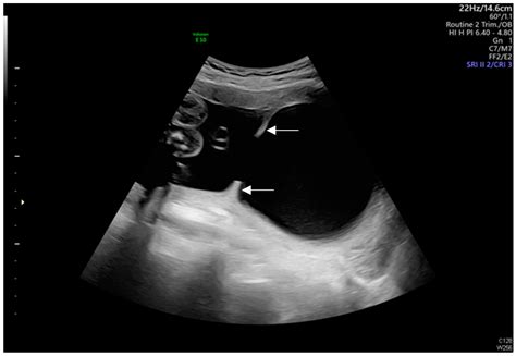 Intrauterine Adhesion-Induced Septated Amniotic Cavity ...