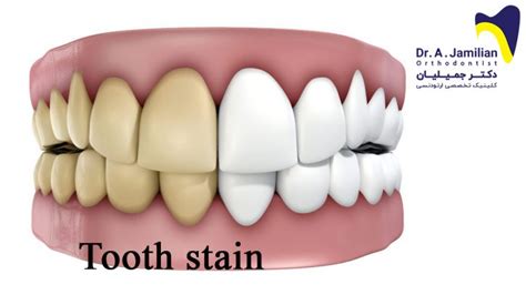 Image result for Tooth Stain