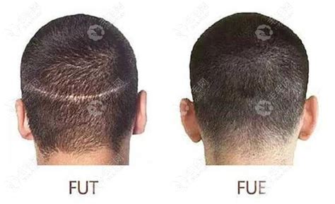 FUT Hair Transplant Surgery | Two Hair Transplant | Ziering Medical