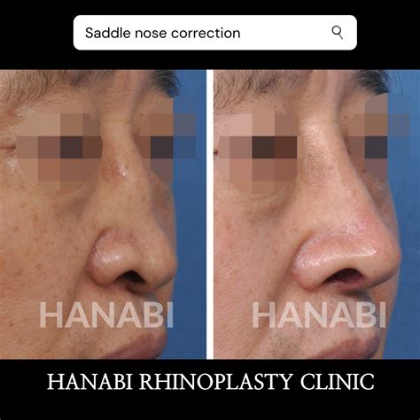 Saddle nose deformity and correction – HANABI RHINOPLASTY CLINIC