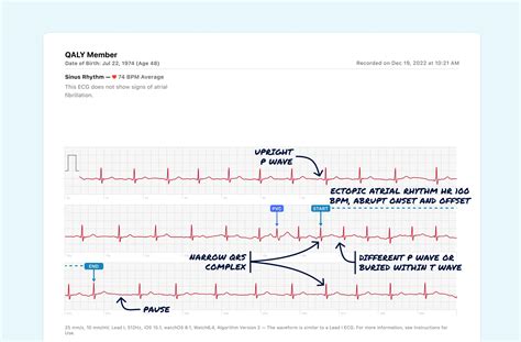 Ectopic Atrial Rhythm Vs. Premature Atrial Contraction (Couplet) on Your Watch ECG | Qaly