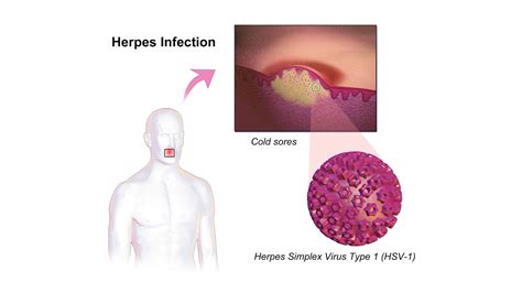 Common Causes Of Fever Blisters Fnaf Sb - Infoupdate.org