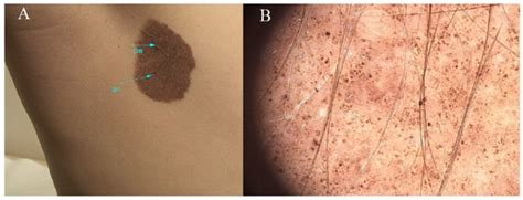 Nevi and Melanoma in Children: What to Do in Daily Medical Practice ...