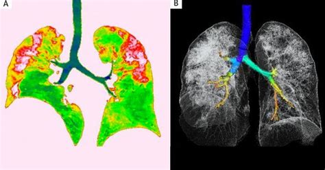 Disturbing X-Ray Images Show The Dastardly Effects Of Coronavirus On ...