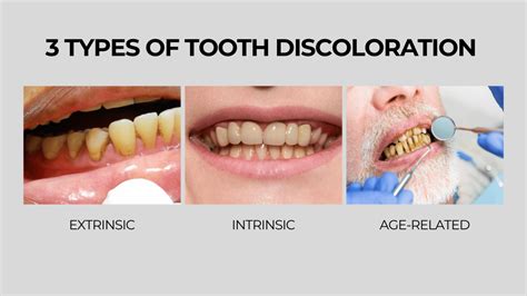 Image result for Discolored Tooth