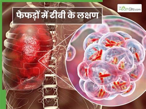 Lungs Me TB Ke Lakshan फेफड़ों में टीबी की शुरुआत होते ही दिखने लगते ...