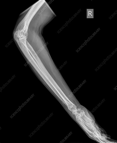 Image result for Distal Radius Fracture Recovery