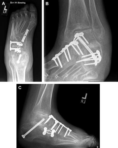 What Is A Triple Arthrodesis Of Foot at Bill Schoenfeld blog