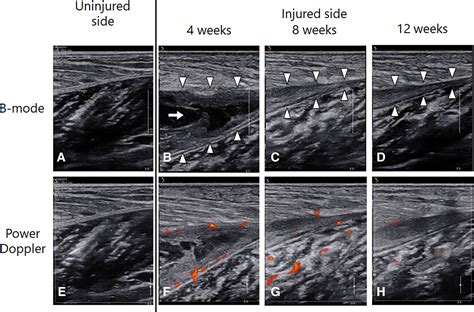 Gastrocnemius Tear Ultrasound