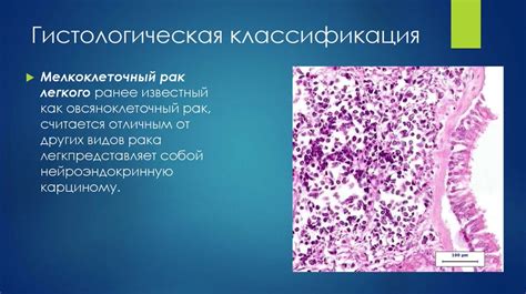 Мелкоклеточный рак легкого. характеристика мелкоклеточного рака легкого