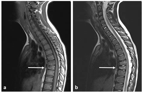Primary Benign Neoplasms of the Spine
