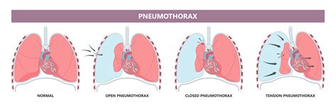 Pneumothorax (collapsed lung) | doctorlansford.com