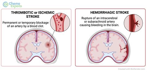 Ischemic Stroke Vs Hemorrhagic Stroke What To Do After A Stroke: