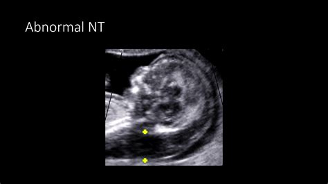 Understanding Nuchal Translucency Thickness: A Key First-Trimester Screening Tool