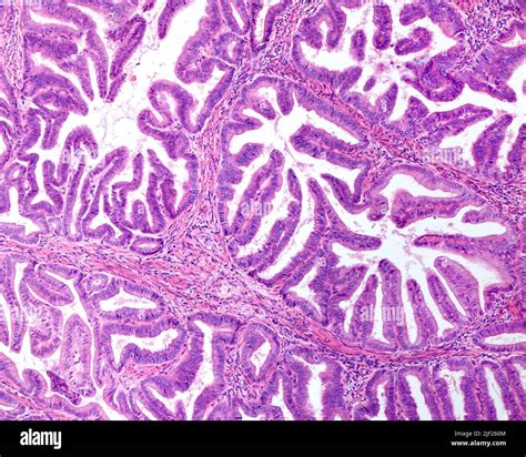 Light micrograph of endometroid carcinoma showing a complex papillary structure with a very ...