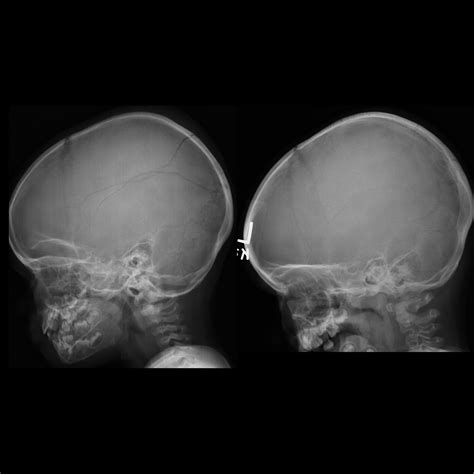 Pediatric Skull Fracture | Pediatric Radiology Reference Article ...