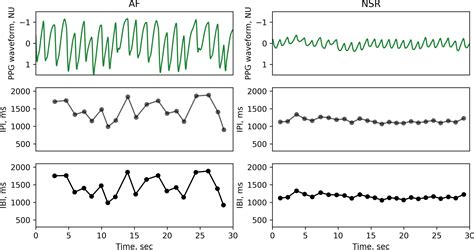 Atrial Fibrillation Detection Using a Novel Cardiac Ambulatory Monitor Based on Photo ...