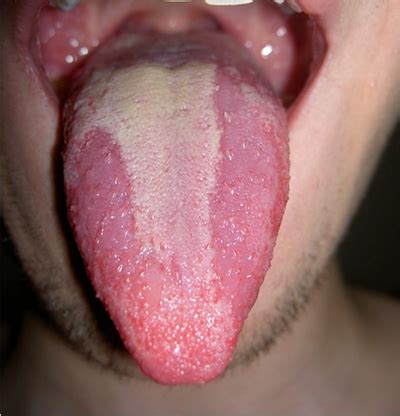 舌炎的症状图片 (8)_有来医生