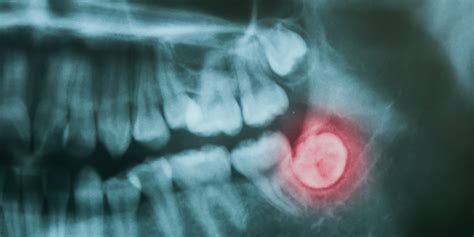 tooth-extraction-x-ray – Soheil Samiei D.M.D., P.C