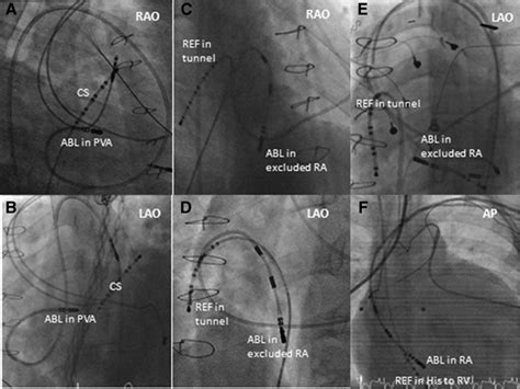 How Dangerous Is Svt Ablation at Colin Fleming blog