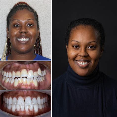 Clear Braces Before And After Orthodontics Invisalign Before & After