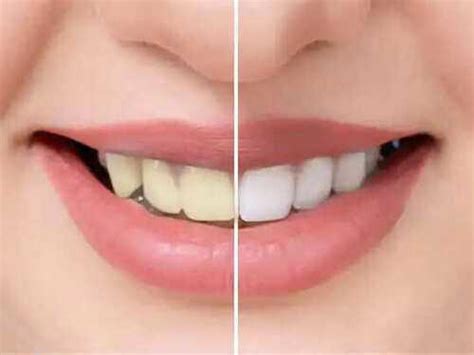 Effective home remedy to combat tooth decay and discoloration