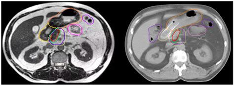 Ablative Five-Fraction CT Versus MR-Guided Stereotactic Body Radiation ...