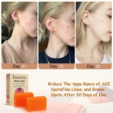 Kojic Acid Before And After