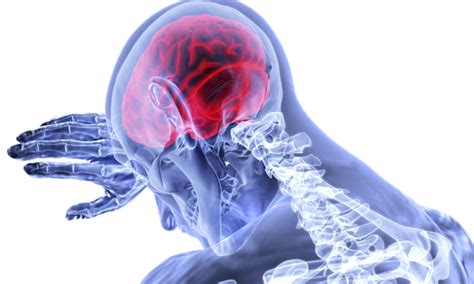 MRI most cost-effective for stroke detection in patients presenting to ...
