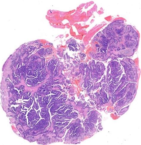 Dermatopathology Society of India: Image of the Month