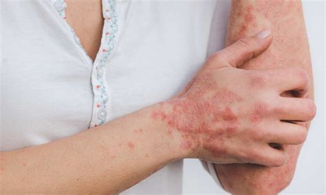 Belimumab improves cutaneous lupus erythematosus in patients with or ...