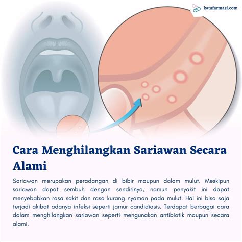 Cara Menghilangkan Sariawan Secara Alami | AtmaGo