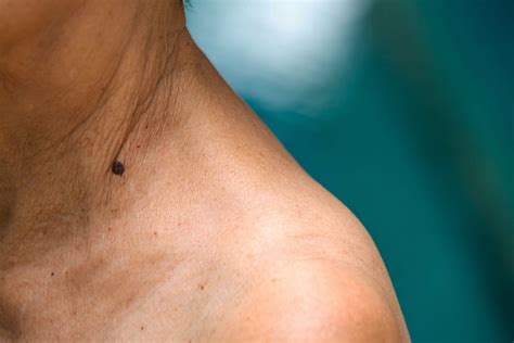 Seborrheic Keratosis Treatment In Boardman, OH