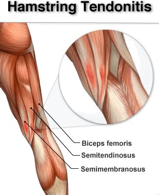 Hamstring Muscle – Function and Importance | Chiropractor Bloomington ...