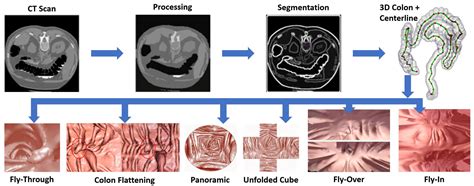 An AI-Based Colonic Polyp Classifier for Colorectal Cancer Screening Using Low-Dose Abdominal CT