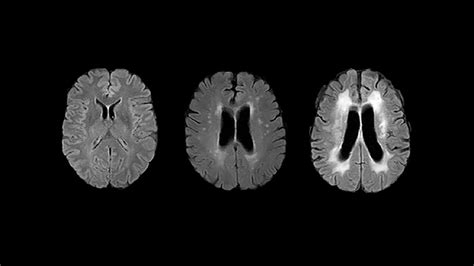 Normal Brain Mri