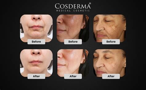 Melano Pack Advanced Yellow Peel for Effective Skin Lightening | Yellow ...