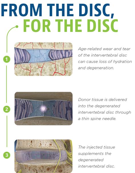 Image result for Via Disc Procedure