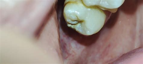Image result for Wisdom Tooth Decayed