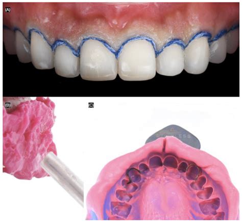 Bonding Protocols for Lithium Disilicate Veneers: A Narrative Review ...