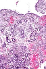 Image result for Disordered Proliferative Endometrium