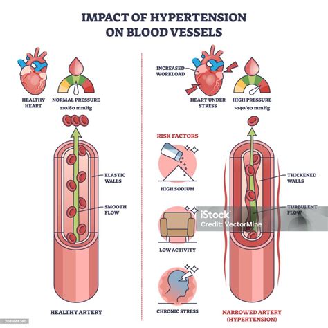 Impact Of Hypertension On Blood Vessels With High Pressure Outline ...