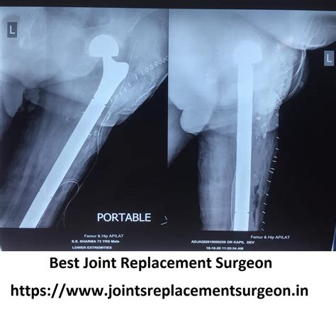 How To Recover Hip Fracture?. What is a hip fracture? | by Joint Jaipur | Medium
