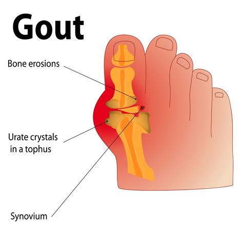 Foot With Gout Appearance at Brock Kyte blog