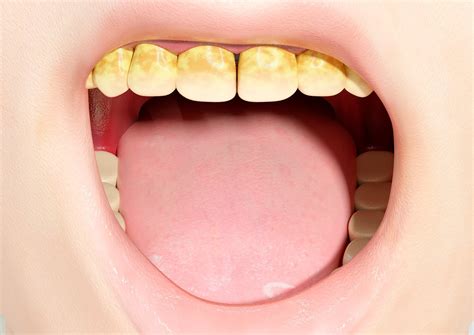 Image result for Stumpy Black Teeth