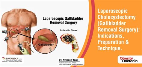 Image result for How Do They Remove a Gallbladder