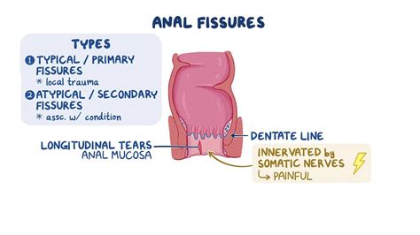 Anal fissure: Video & Meaning | Osmosis
