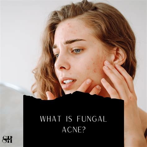 What Is Fungal Acne? - Skin Harmonics