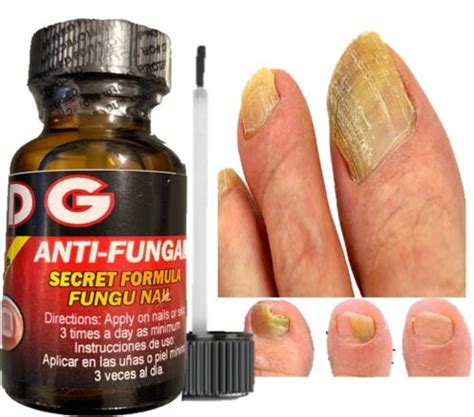 Hongos Uñas Tratamiento para Eliminar Onicomicosis | Ubuy India