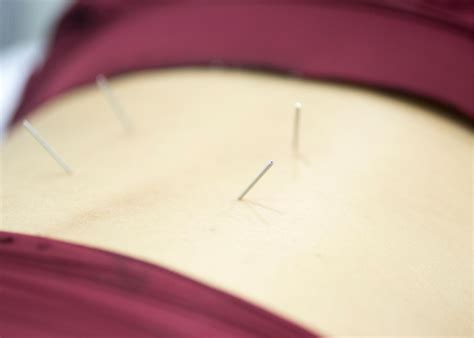 Depth Acupuncture Muscle Pain Deep Pressure Trigger Therapy Massage ...